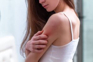 Young woman suffering from itchy skin and scratching an itch on one of her arms.